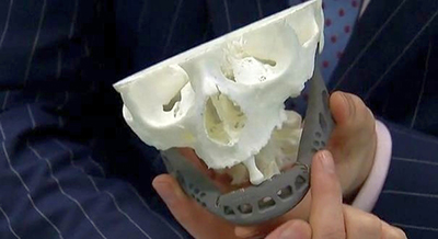 10- 3D Yazıcılarla Üretilmiş Olan Çene Kalıpları